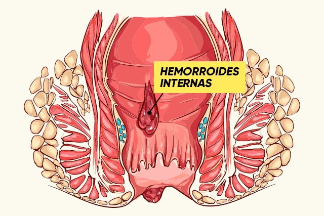Cómo Identificar Si Son Hemorroides Y Cuál Es Su Tratamiento Tua Saúde
