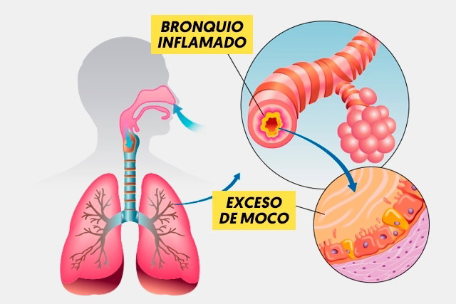 Astmatisk Bronkit Vad Det R Symtom Och Behandling Tua Sa Askorbde Mutual Holding