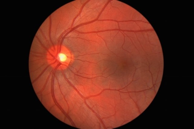 Retinografia de uma retina saudável