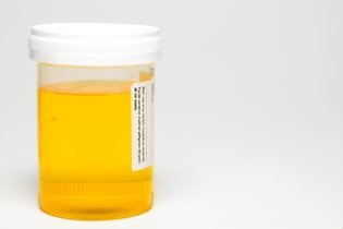Células epiteliais na urina: o que pode ser e como entender o exame