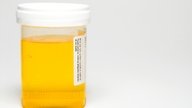 Células epiteliais na urina: o que pode ser e como entender o exame