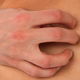 Dermatofitose: o que é, tipos, sintomas e tratamento
