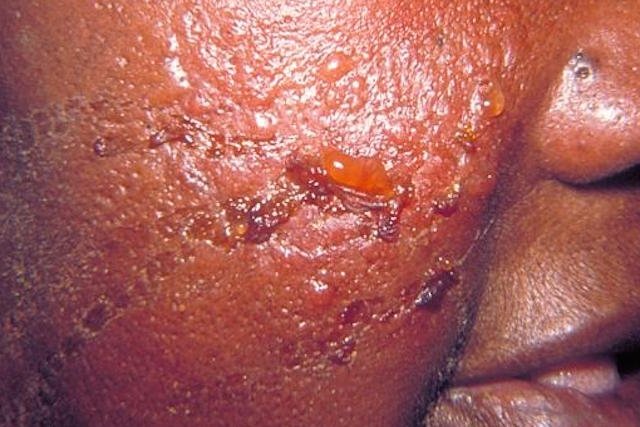 ما هو تقيح الجلد وأهم أعراضه وعلاجه؟