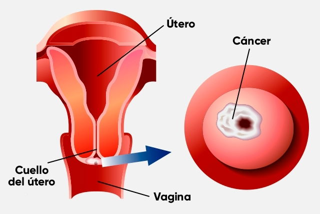 sintomas de cancer de utero