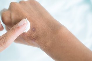 Imagem ilustrativa do artigo Como tirar manchas da pele causadas por feridas?