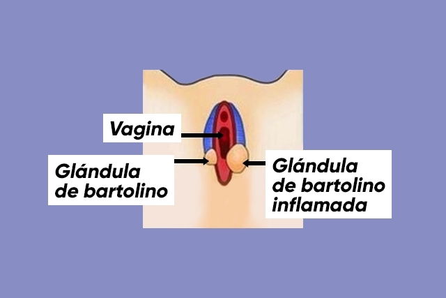 Como Tratar La Bartolinitis En Casa 2601