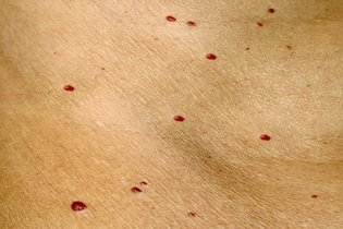 Illustrative image of the article Cherry Angioma: What It Looks Like, Causes & Treatment