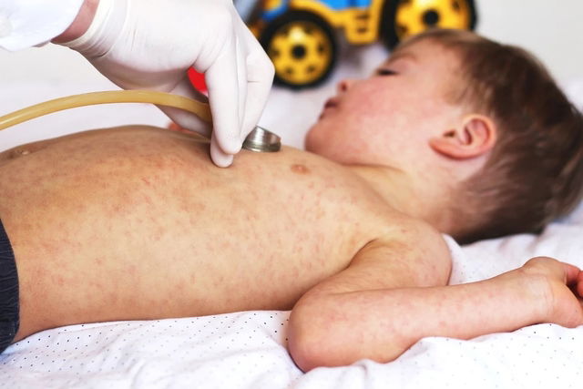 Niño con sarampión siendo evaluado por el médico