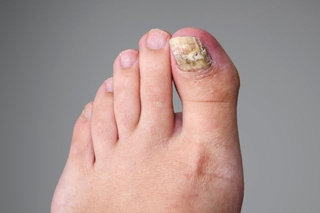 Caratin Rx Blog: Why Does Your Nail Fungus Keep Coming Back?