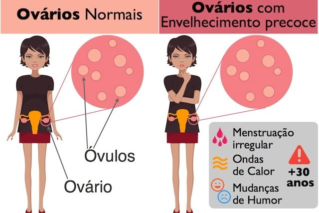 O que acontece nos ovários em envelhecimento e sintomas da menopausa precoce