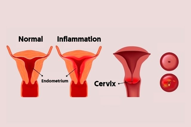 Endometritis: Symptoms, Causes & Treatment - Tua Saúde