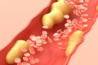 Imagen ilustrativa del artículo Colesterol VLDL (bajo o alto): valores normales y por qué ocurre 
