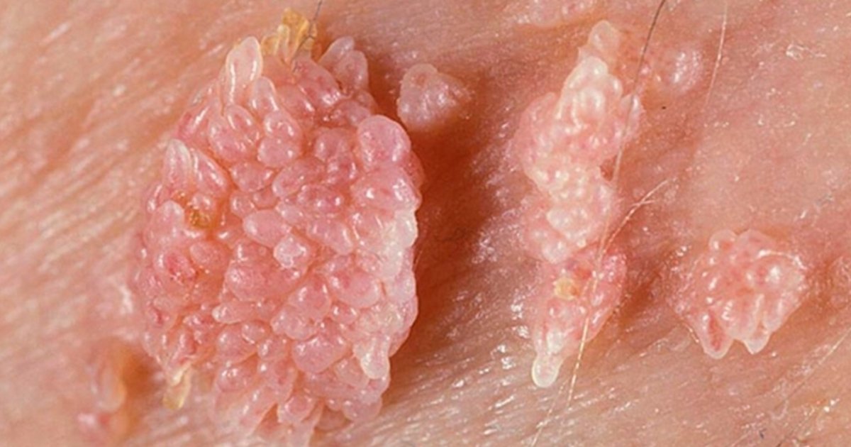 genitali papilloma virus