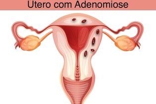 Aparência de um útero com adenomiose com tecido dentro do músculo