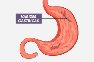 Imagem ilustrativa do artigo Varizes no estômago: o que são, sintomas, causas e tratamento