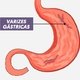 Varizes no estômago: o que são, causas e tratamento