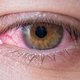Olho vermelho: 9 causas comuns e o que fazer