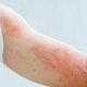14 doenças que causam manchas vermelhas na pele