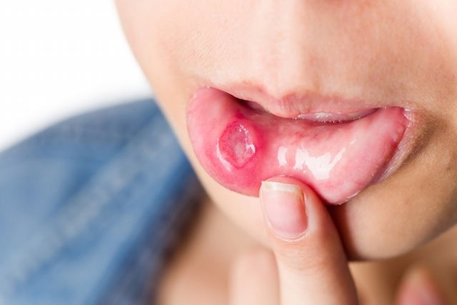 5 Easy Ways To Get Rid Of Mouth Ulcers Faster Tua Saude