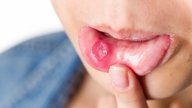 5 Easy Ways to Get Rid of Mouth Ulcers