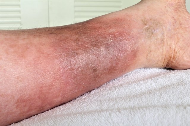 Foto de dermatite ocre na perna