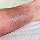 Dermatite ocre: o que é, sintomas, causas e tratamento