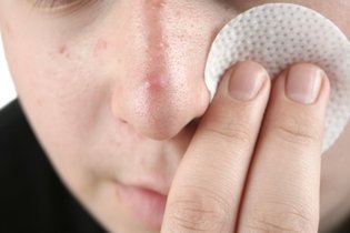 Imagem ilustrativa do artigo Como limpar a pele com acne