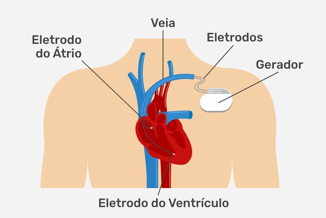 Confira o que muda na vida de quem tem marcapasso - Saúde