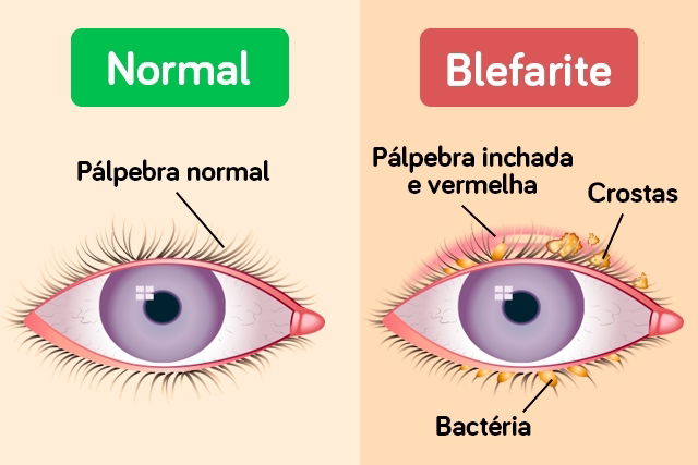 Como a blefarite afeta os olhos – Donato Hospital de Olhos