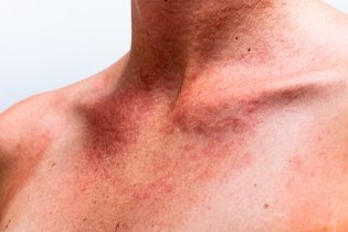 Bumps on Skin: Causes, What to Do & Pictures