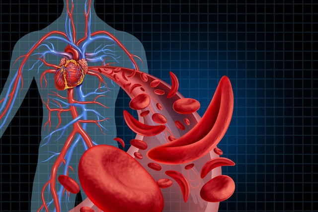 Anemia Falciforme Síntomas Causas Y Tratamiento Tua Saúde 