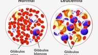 Leucemia: tipos, causas y tratamiento