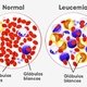 Leucemia: tipos, causas y tratamiento