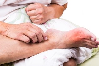 Illustrative image of the article What is Gout? Causes, Symptoms & Treatment