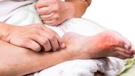 Gout: What Is It, Symptoms, Causes & Treatment Options