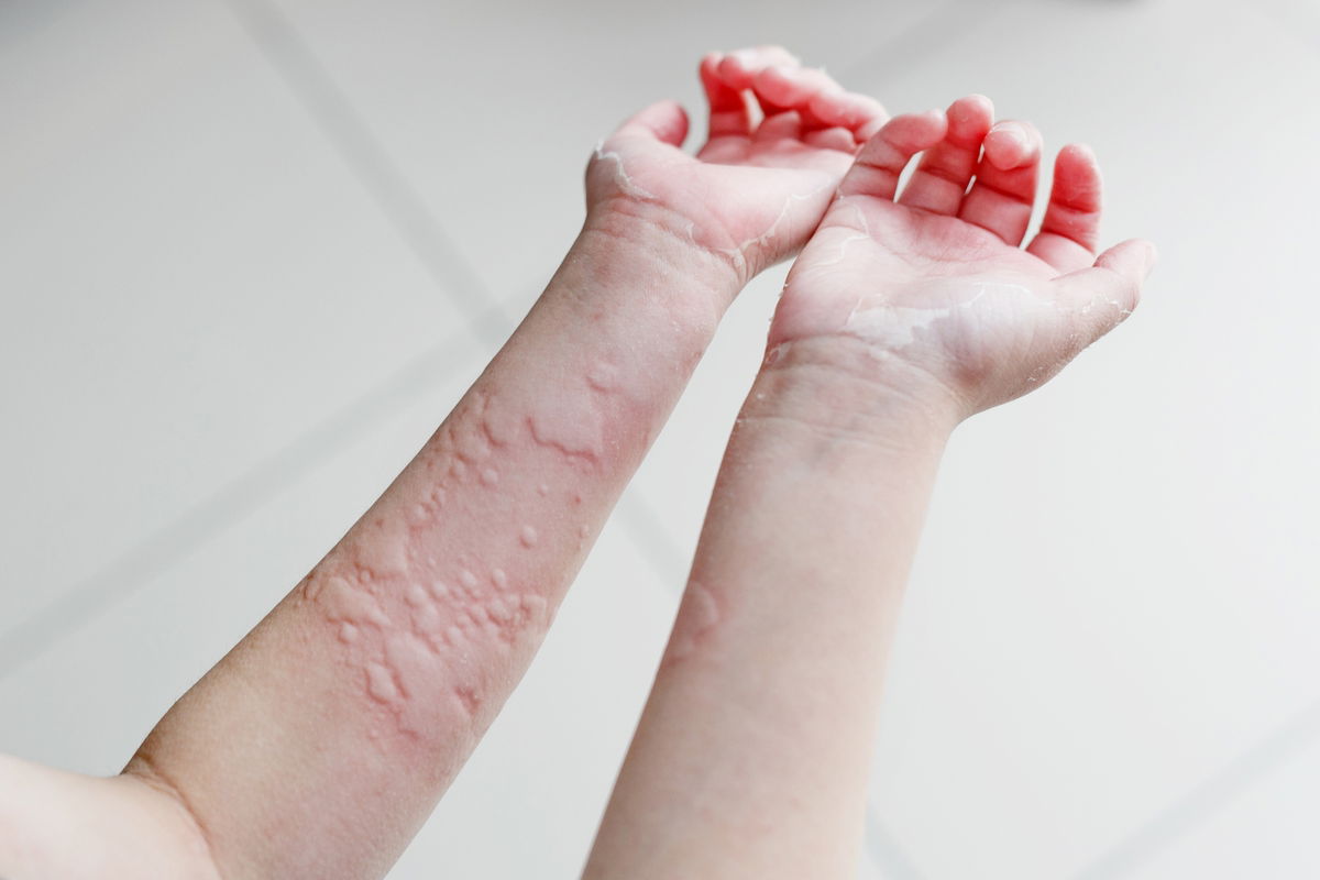 What To Do About Hives On Hands