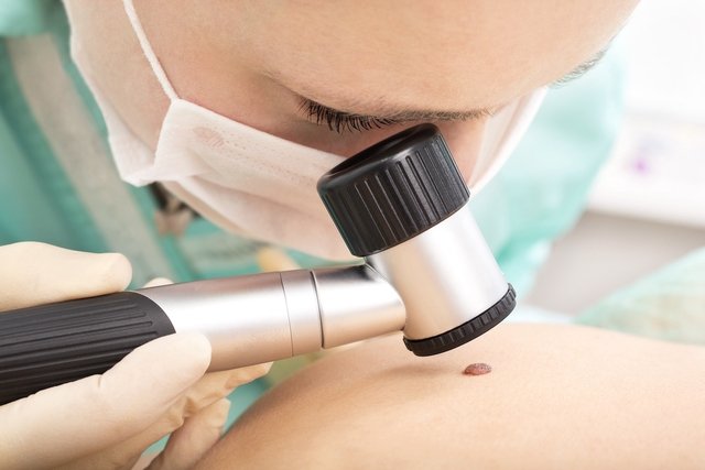 Médico dermatologista com um aparelho dermatoscopio examinando um nevo melanocítico ou pinta na pele