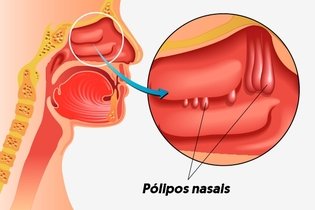 Pólipo nasal: o que é, sintomas, causas, tratamento e cirurgia