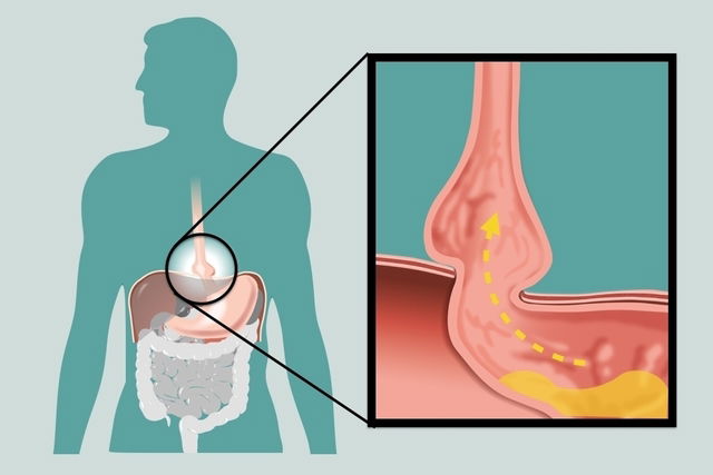 Refluxo gastroesofágico: o que é, sintomas e tratamento