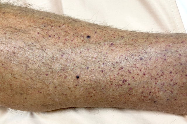 purpura on arms