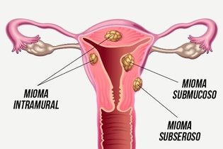 Tipos de mioma uterino: principais sintomas e como tratar