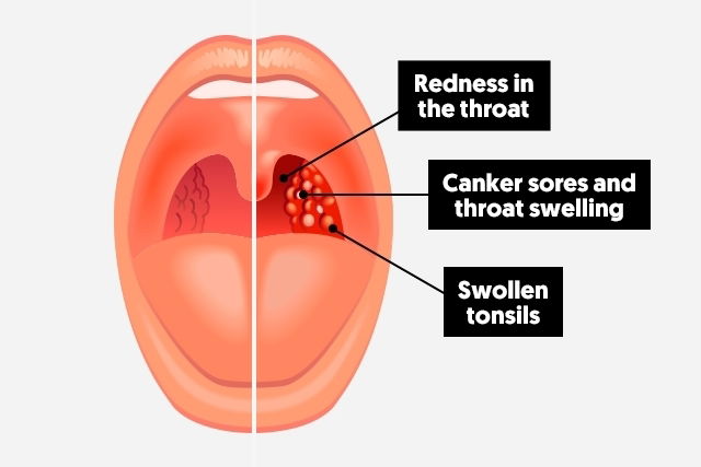 Sore Throat How To Get Rid Of It Faster Tua Saude