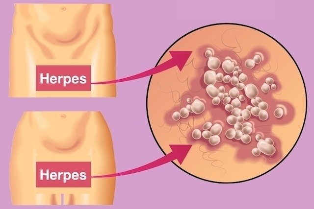 Saiba como se pega e como se proteger da Herpes