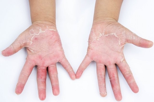 Calificación Tomate Embutido Dermatitis en las manos: síntomas, causas y tratamiento