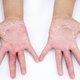 Alergia nas mãos: causas, sintomas e tratamento
