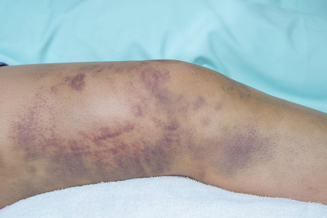 Purpura: Blood Spots, Thrombocytopenic, Symptoms & Causes