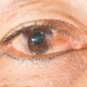 Mancha amarela no olho: 3 principais causas e o que fazer