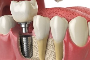 Imagem ilustrativa do artigo Prótese dentária: o que é, tipos, quando usar e cuidados