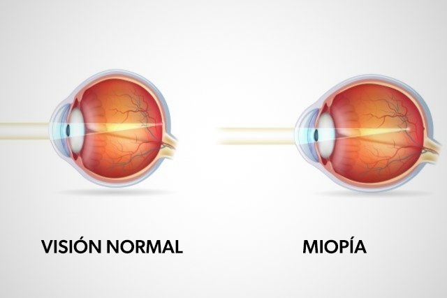 miopie medicinală vedere slabă și tratamente