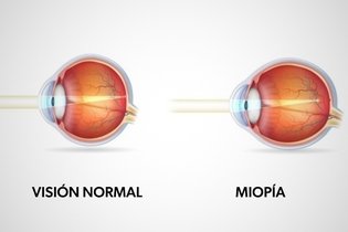 Imagen ilustrativa del artículo Miopía: qué es, causas y tratamiento